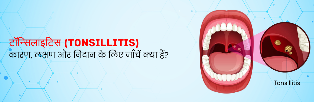 टॉन्सिलाइटिस: इसके कारण, लक्षण और निदान के लिए जाँचें क्या हैं?